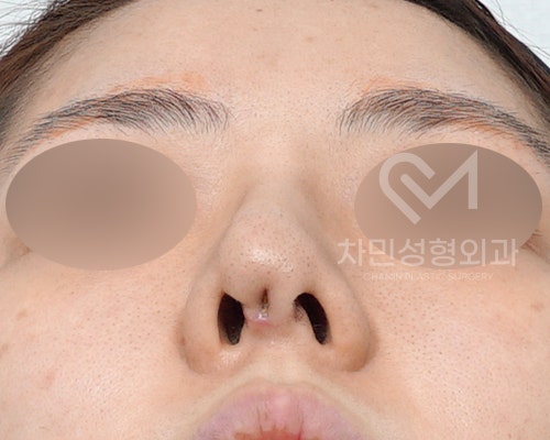 튀어나온 메드포어 제거, 실리콘,  비주 피부 결손, 돌출 및 패임, 염증 진행 중 관련 이미지 2