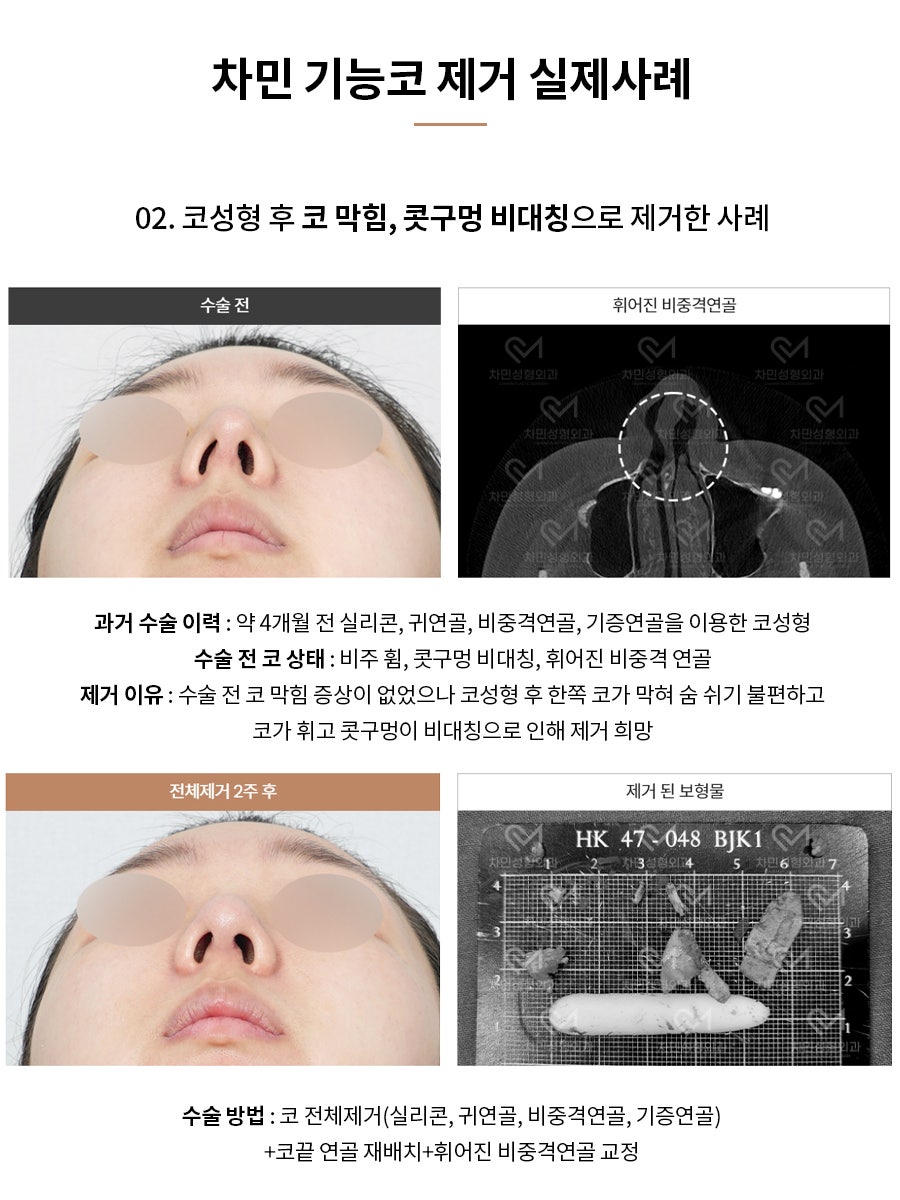 코수술 후 코막힘, 이물감, 불안할 때 [차민 기능코제거] 관련 이미지 6