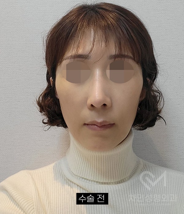 Removal of Nose Silicone, Ear Cartilage, Medpor, and Tip Cartilage Repositioning (Before Surgery ~ 2 Months) image 12