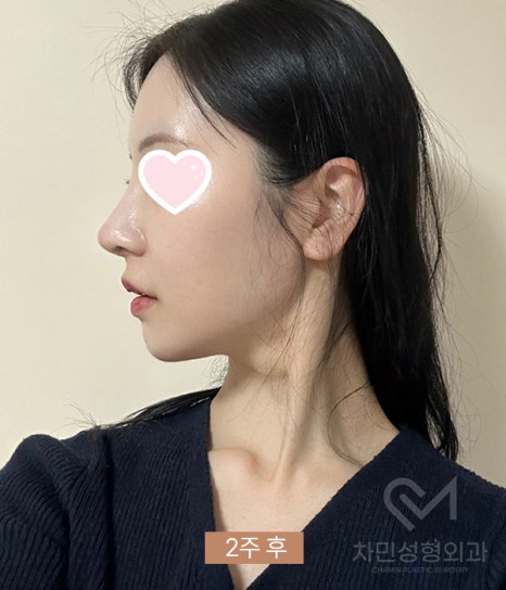 2 Weeks After Rib Cartilage Rhinoplasty: Short Nose Surgery Review, Columella Correction Case image 8