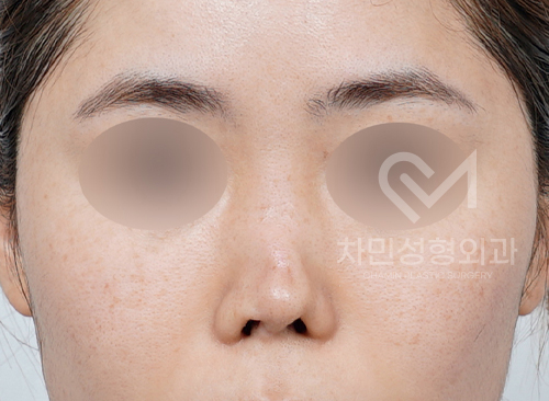 Ninth Revision Rhinoplasty for Contracted Nose: Pinched Nose, Depression, Autologous Rib Cartilage, Saddle Nose image 1