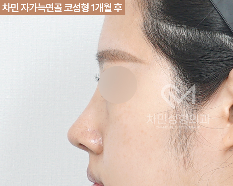 코수술 자가늑 1개월 : 짧은코, 들창코 케이스 리뷰 관련 이미지 6
