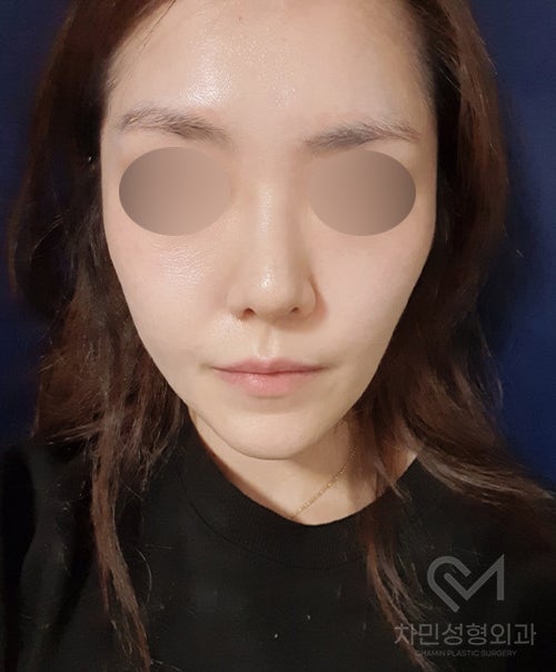 튀어나온 메드포어 제거, 실리콘,  비주 피부 결손, 돌출 및 패임, 염증 진행 중 관련 이미지 16