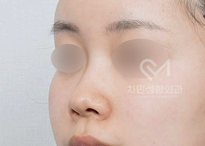 Female Straight Nose: Case Review of a Well-Known Rhinoplasty Clinic! image 2