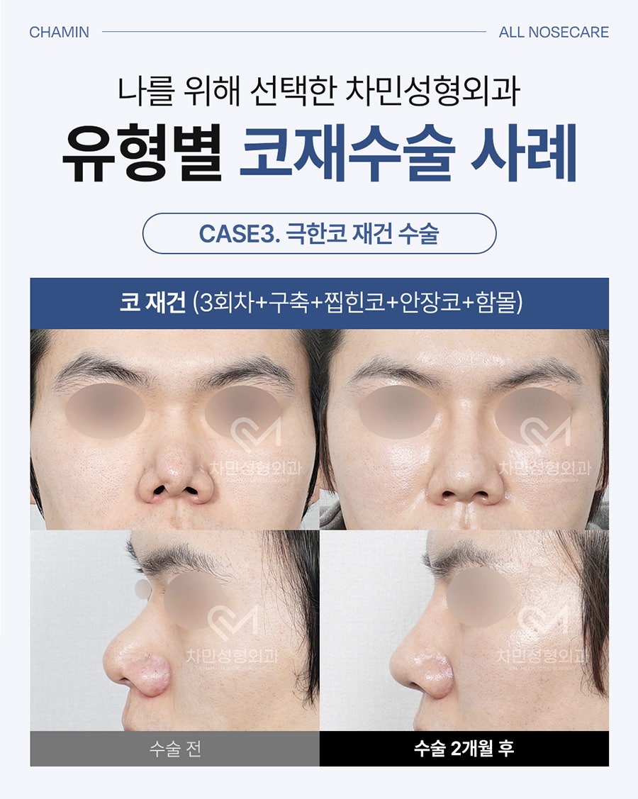Cha Min Plastic Surgery’s All Nose Care Solution, from Nose Surgery to Nasal Reconstruction! image 7