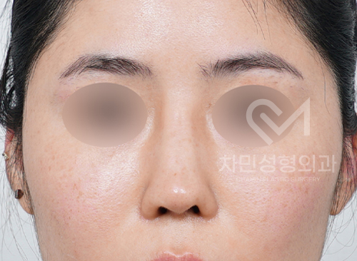 Ninth Revision Rhinoplasty for Contracted Nose: Pinched Nose, Depression, Autologous Rib Cartilage, Saddle Nose image 10