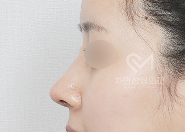 Female Straight Nose: Case Review of a Well-Known Rhinoplasty Clinic! image 5