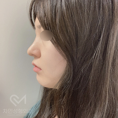 Case Review of Total Nose Removal (Removal of Donated Rib Cartilage, Cartilage Repositioning) ｜Director Minseong Kim image 8