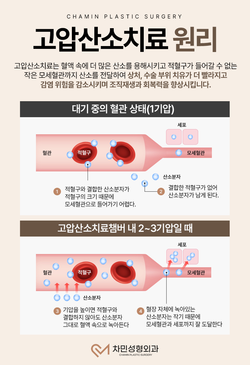 Hyperbaric Oxygen Therapy Cost, Clinic, Effects (Contracted Nose, Tinnitus, Sudden Hearing Loss, Immunity...) image 4