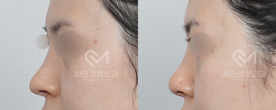 Case Review of Total Nose Removal (Removal of Donated Rib Cartilage, Cartilage Repositioning) ｜Director Minseong Kim image 6