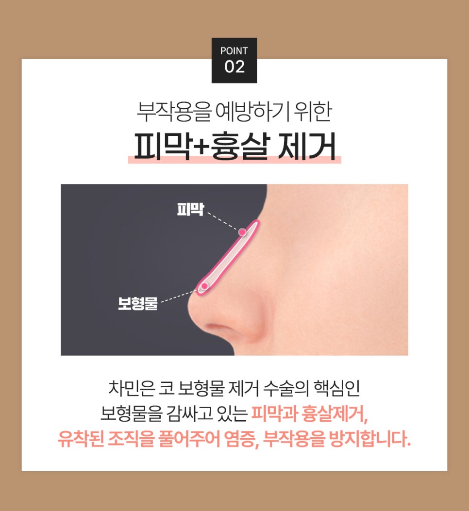 코 보형물 제거 : 차민성형외과에서 모태코로 돌아가기 관련 이미지 6