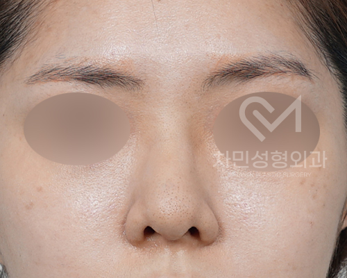 튀어나온 메드포어 제거, 실리콘,  비주 피부 결손, 돌출 및 패임, 염증 진행 중 관련 이미지 7