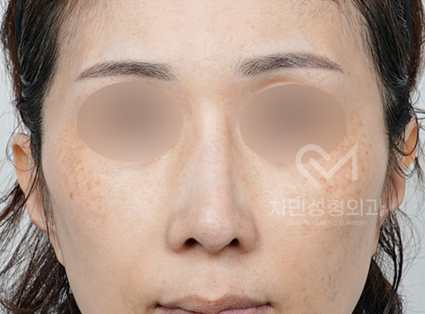 Removal of Nose Silicone, Ear Cartilage, Medpor, and Tip Cartilage Repositioning (Before Surgery ~ 2 Months) image 1