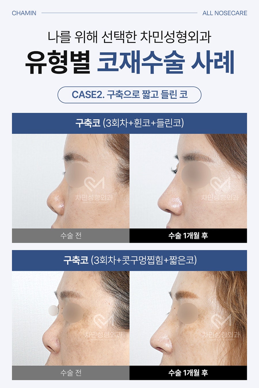 Cha Min Plastic Surgery’s All Nose Care Solution, from Nose Surgery to Nasal Reconstruction! image 6