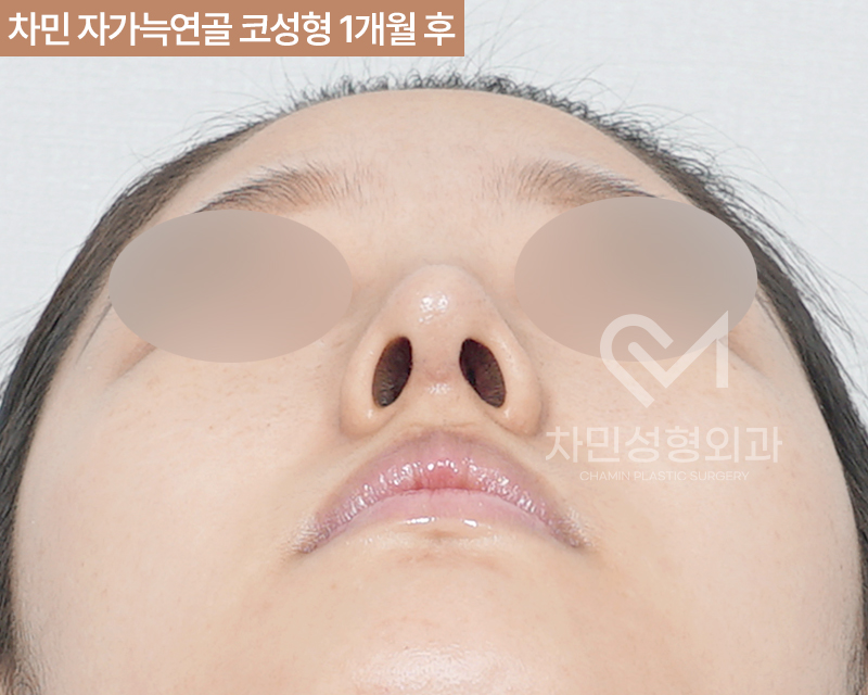 코수술 자가늑 1개월 : 짧은코, 들창코 케이스 리뷰 관련 이미지 9