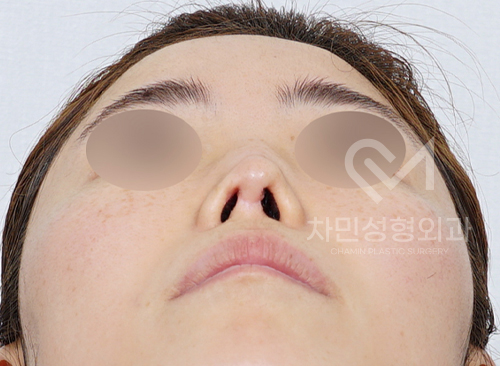 Ninth Revision Rhinoplasty for Contracted Nose: Pinched Nose, Depression, Autologous Rib Cartilage, Saddle Nose image 4
