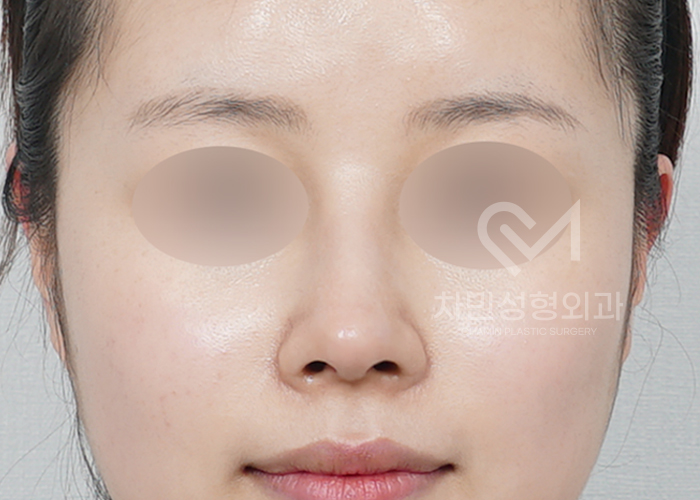 Female Straight Nose: Case Review of a Well-Known Rhinoplasty Clinic! image 4