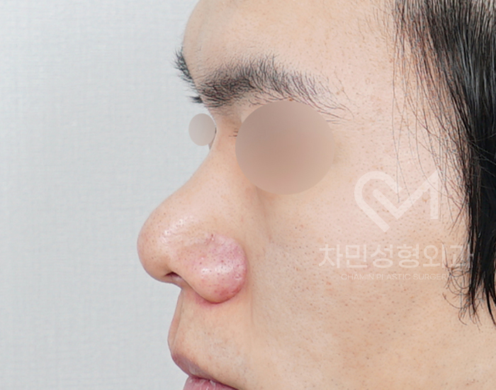 코재건 수술 (안장코, 찝힌코, 함몰, 구축) 극한코 사례 관련 이미지 4