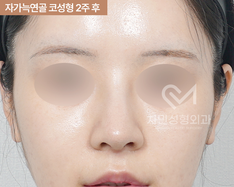 2 Weeks After Rib Cartilage Rhinoplasty: Short Nose Surgery Review, Columella Correction Case image 4
