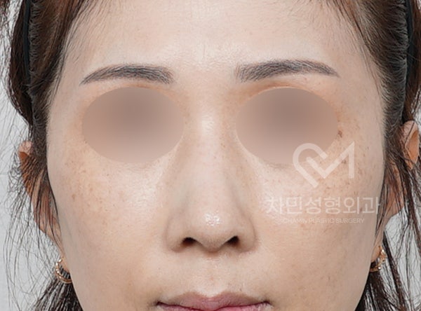Removal of Nose Silicone, Ear Cartilage, Medpor, and Tip Cartilage Repositioning (Before Surgery ~ 2 Months) image 7