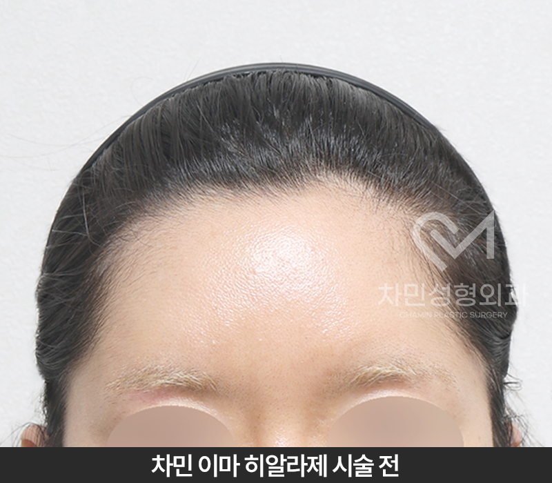 이마필러 녹이기, 필러 녹이는 주사 비용, 병원은? 차민성형외과 관련 이미지 3