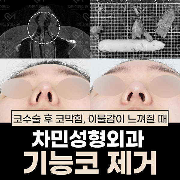 코수술 후 코막힘, 이물감, 불안할 때 [차민 기능코제거] 관련 이미지 1
