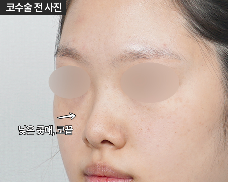 코수술 자가늑 1개월 : 짧은코, 들창코 케이스 리뷰 관련 이미지 4