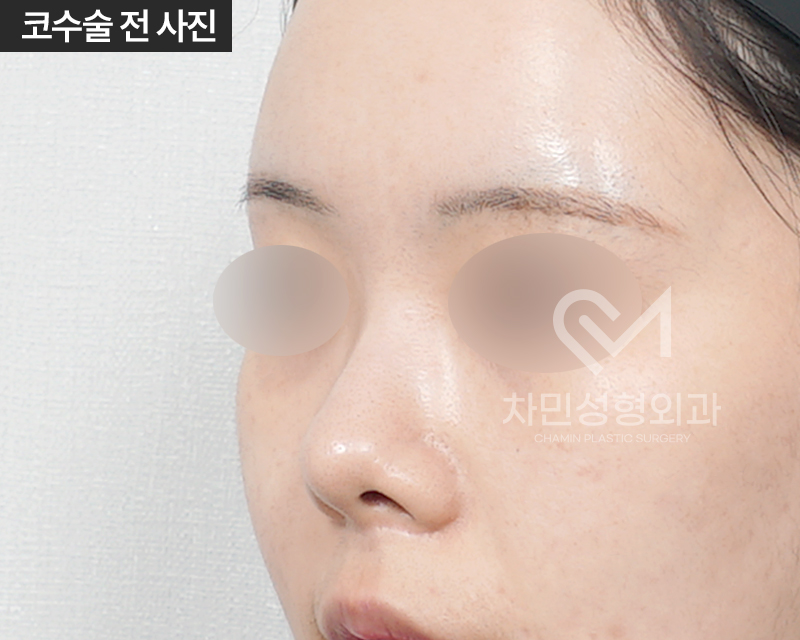 2 Weeks After Rib Cartilage Rhinoplasty: Short Nose Surgery Review, Columella Correction Case image 2
