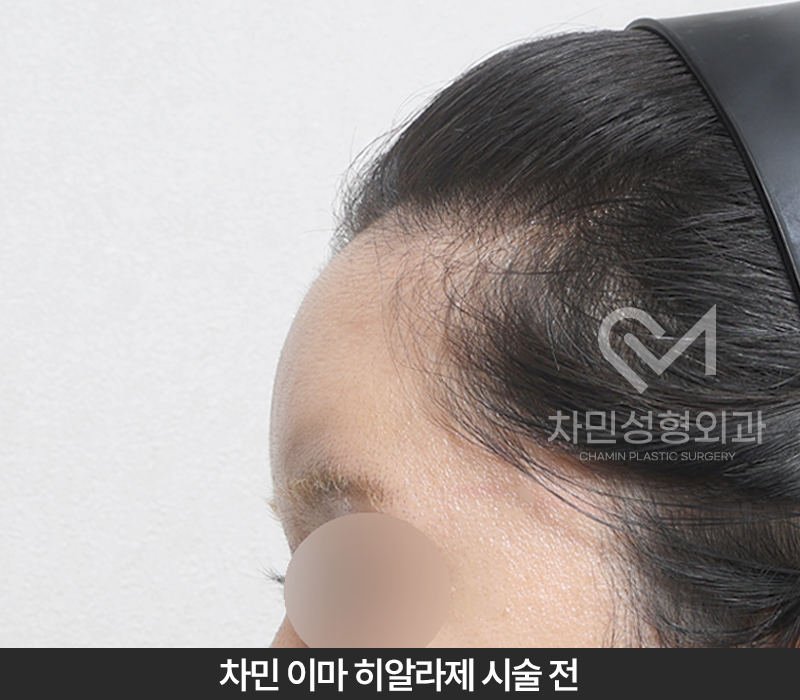 이마필러 녹이기, 필러 녹이는 주사 비용, 병원은? 차민성형외과 관련 이미지 4