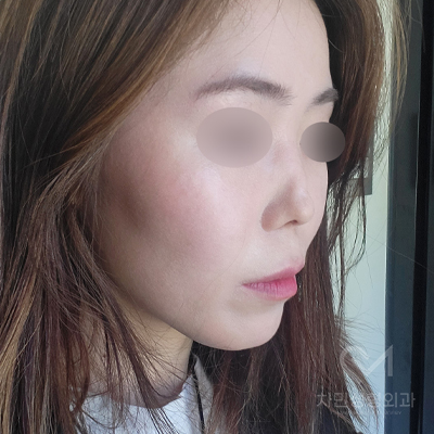 Ninth Revision Rhinoplasty for Contracted Nose: Pinched Nose, Depression, Autologous Rib Cartilage, Saddle Nose image 18