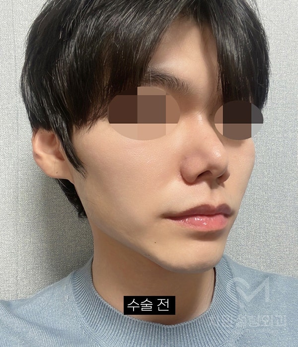 코재건 수술 (안장코, 찝힌코, 함몰, 구축) 극한코 사례 관련 이미지 12