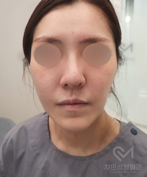 튀어나온 메드포어 제거, 실리콘,  비주 피부 결손, 돌출 및 패임, 염증 진행 중 관련 이미지 15