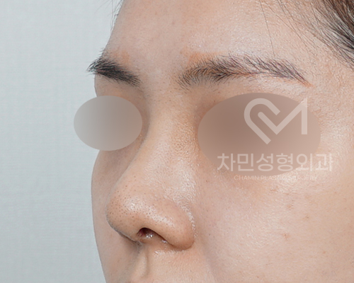 튀어나온 메드포어 제거, 실리콘,  비주 피부 결손, 돌출 및 패임, 염증 진행 중 관련 이미지 9