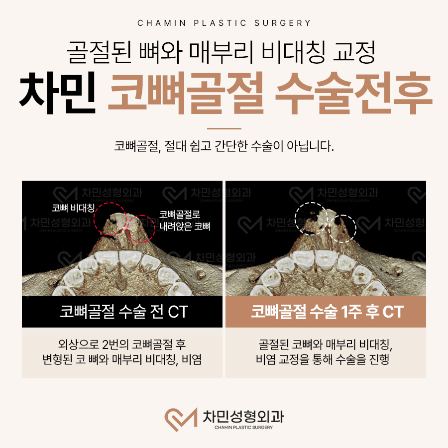 코뼈 골절 병원, 수술, 부러짐 증상이 느껴질 때 당일 진료! 관련 이미지 10