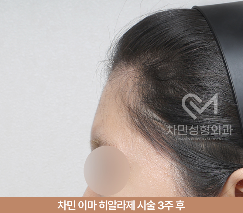 이마필러 녹이기, 필러 녹이는 주사 비용, 병원은? 차민성형외과 관련 이미지 8