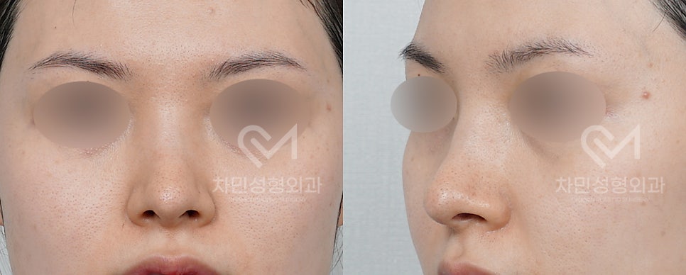 Case Review of Total Nose Removal (Removal of Donated Rib Cartilage, Cartilage Repositioning) ｜Director Minseong Kim image 3
