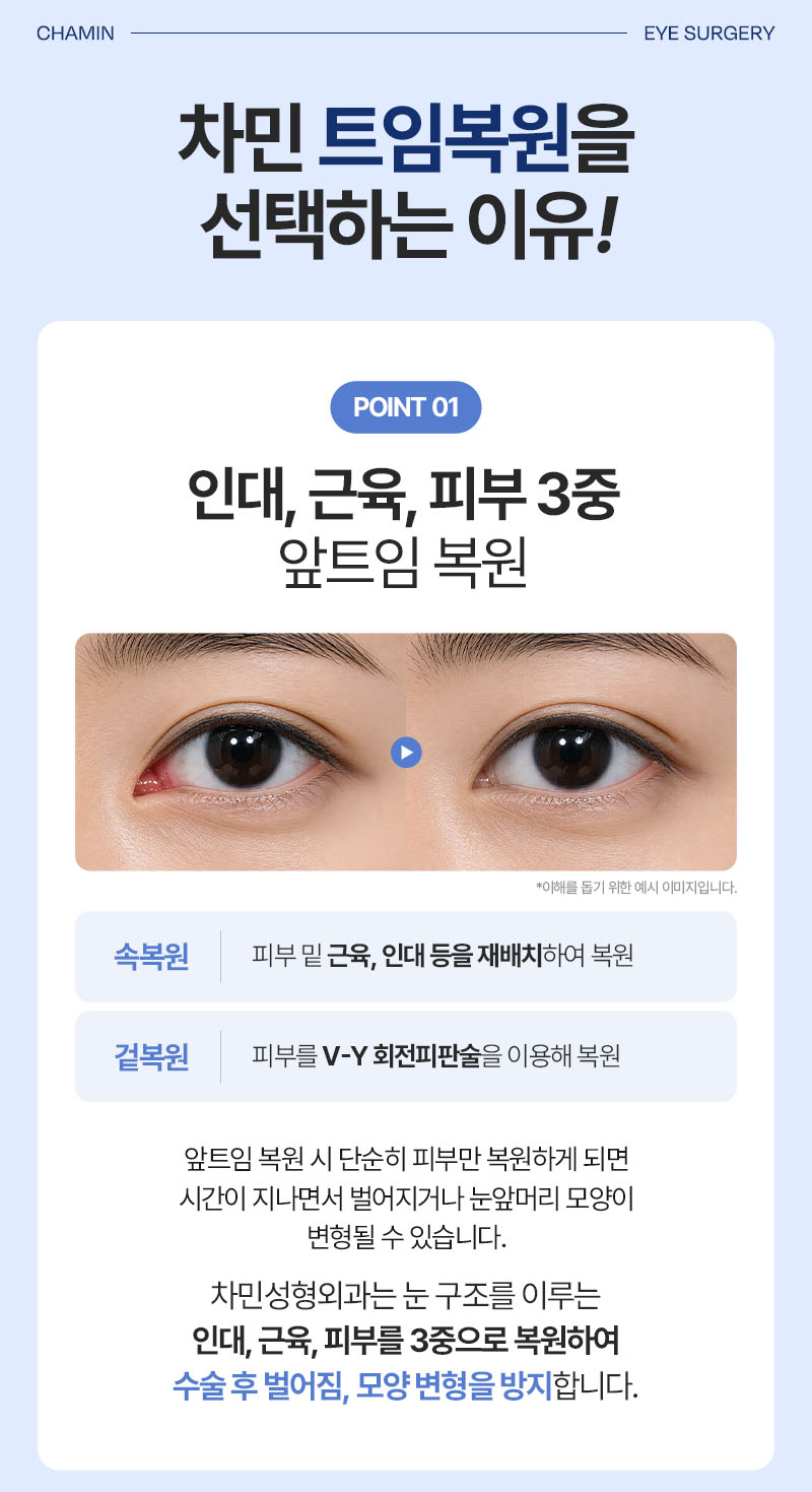 Eyelid Corner Revision and Reconstruction, Including Reoperation! Cha Min Plastic Surgery image 5
