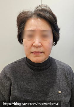 Dangsan Station Dermatology Oligio Lifting image 1
