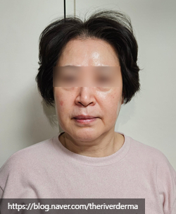 Dangsan Station Dermatology Oligio Lifting image 2