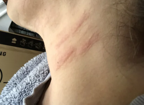 슈링크 화상 부작용, 정말 생길 수 있을까? 영등포 피부과 전문의 관련 이미지 3