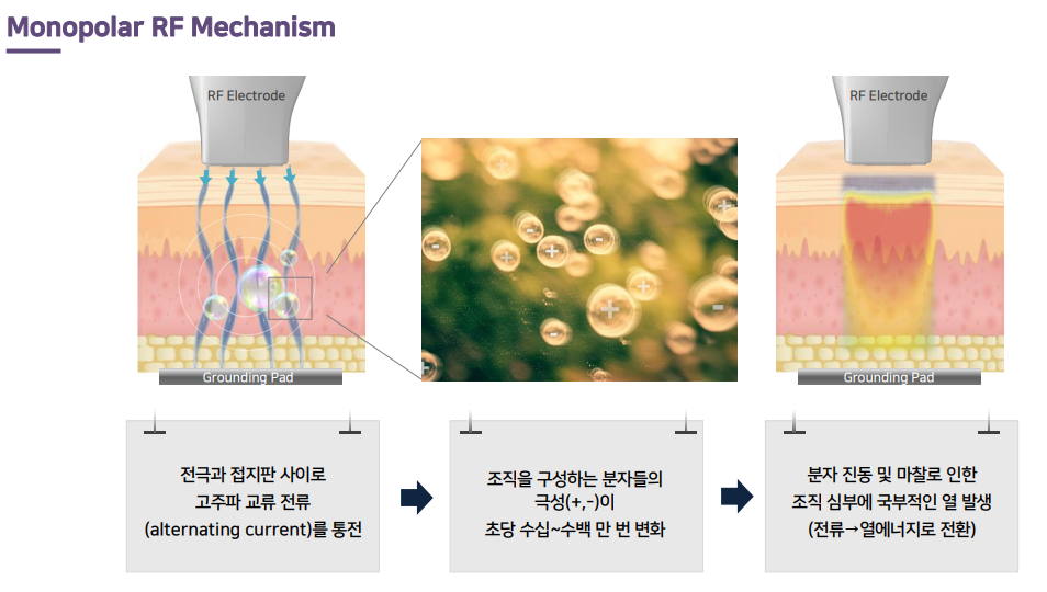 당산 올리지오, 한국인 피부에 딱 맞는 탄력 고주파 리프팅 관련 이미지 4