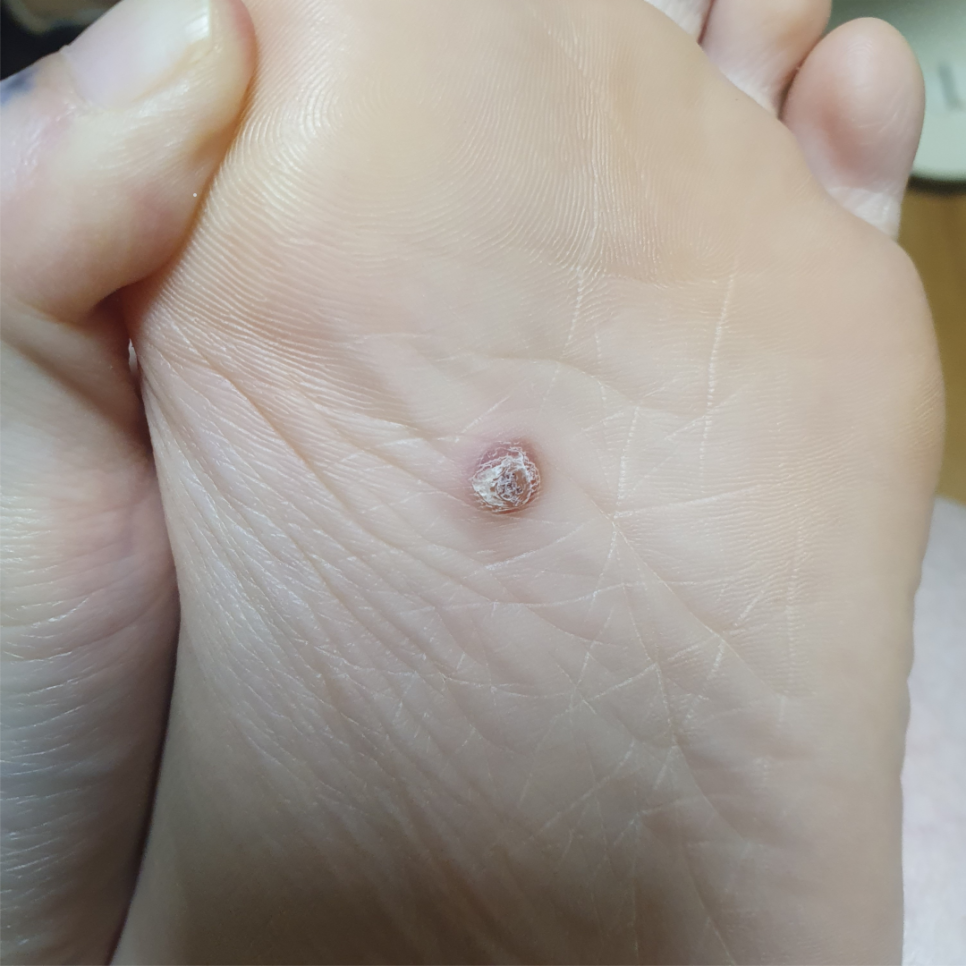 Yeongdeungpo Warts: Common but Tricky, So Early Treatment Is Important image 2