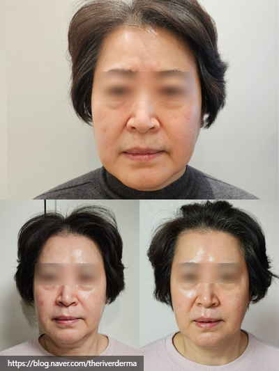 Dangsan Station Dermatology Oligio Lifting image 3