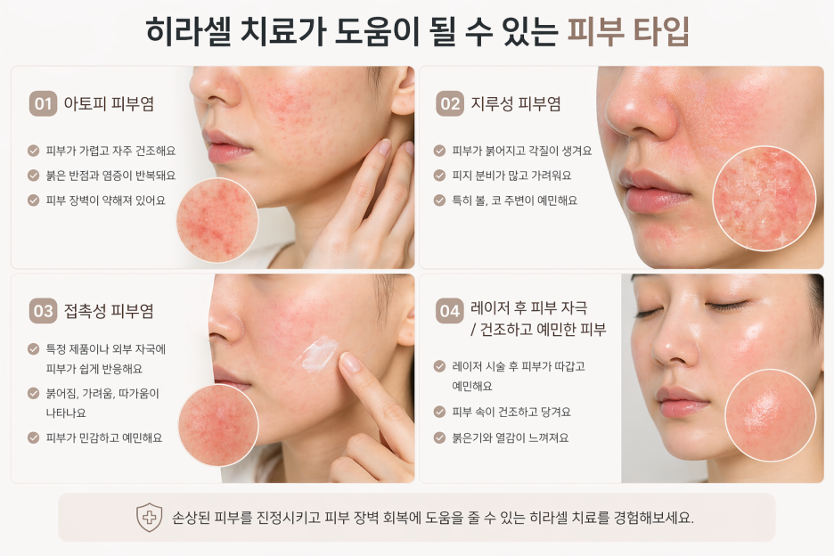 Daerim Station Dermatology Specialist HYLACELL Treatment, Restoring Damaged Skin Barrier Care image 4