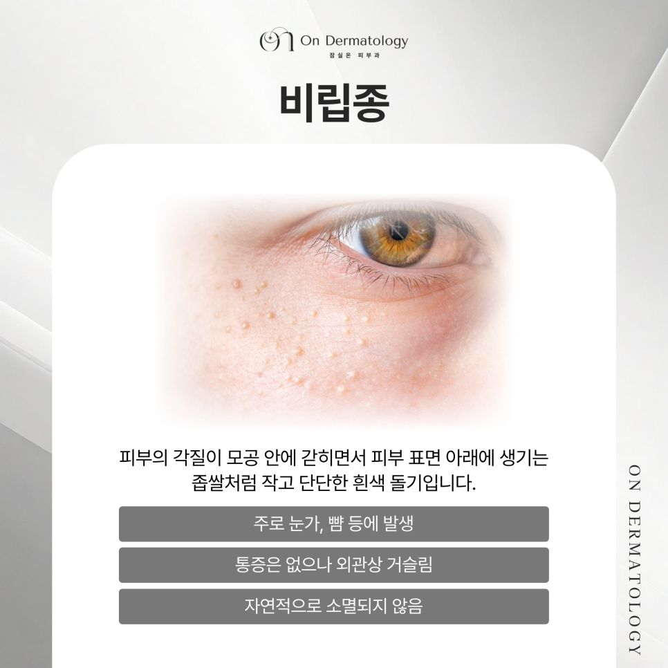 잠실 피부과 전문의 편평사마귀와 비립종 CO2레이저, 진행과정 및 치료 후 관리법 관련 이미지 4