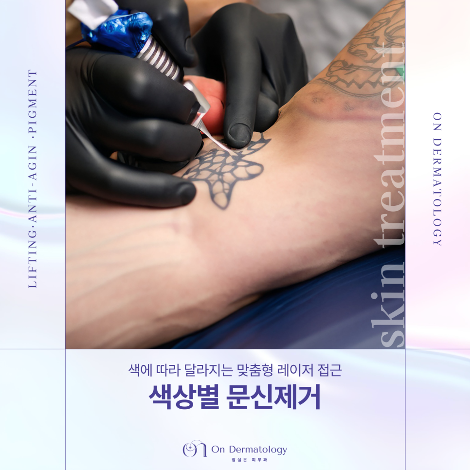 Songpa Dermatology Tattoo Pico Laser Tattoo Removal: Why Is Color-Specific Tattoo Removal More Difficult? image 1