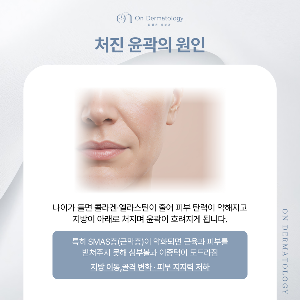 얼굴 윤곽 고민, 잠실피부과 티타늄과 리니어지 리프팅으로 처진 윤곽 개선하기 관련 이미지 2