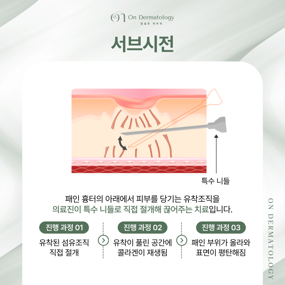 잠실피부과 피코MLA 및 서브시전 포함 흉터 복합 재생치료, 여러 치료 병행하는 이유? 관련 이미지 4