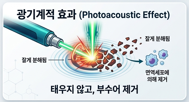 문신 제거는 왜 피코레이저가 유리할까? TRT(Thermal Relaxation Time)부터 이해해보자 관련 이미지 3