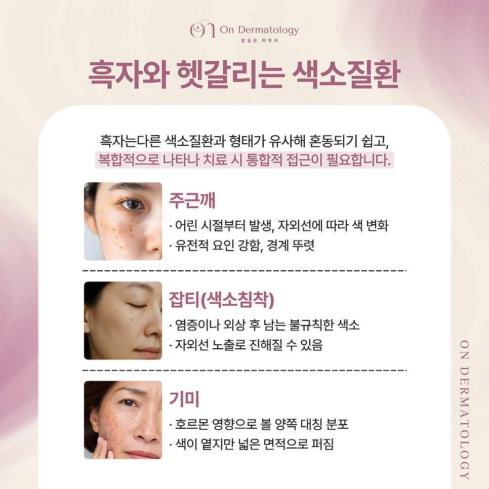 송파피부과 흑자 등 색소 피코레이저를 이용한 토닝 치료, 치료가 까다로운 이유? 관련 이미지 4